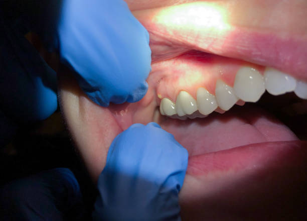 Best Emergency Tooth Extraction in Fargo, ND
